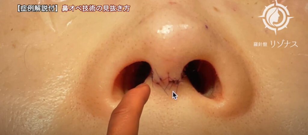 鼻中隔の縫合 画像