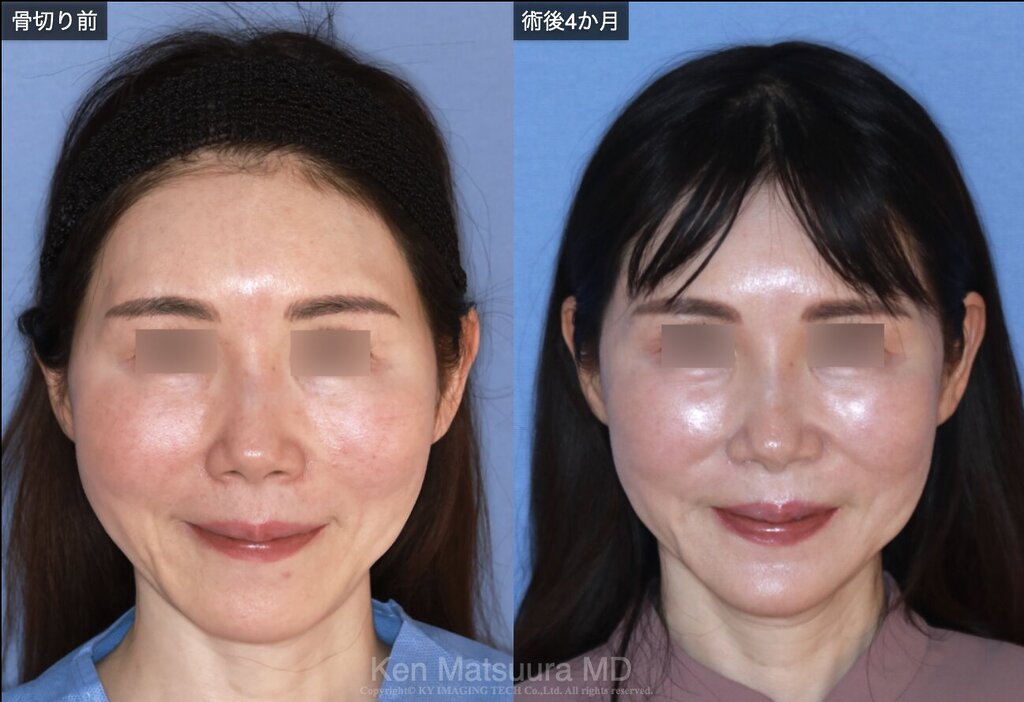 ブーストハイフ 50代症例 リゾナス