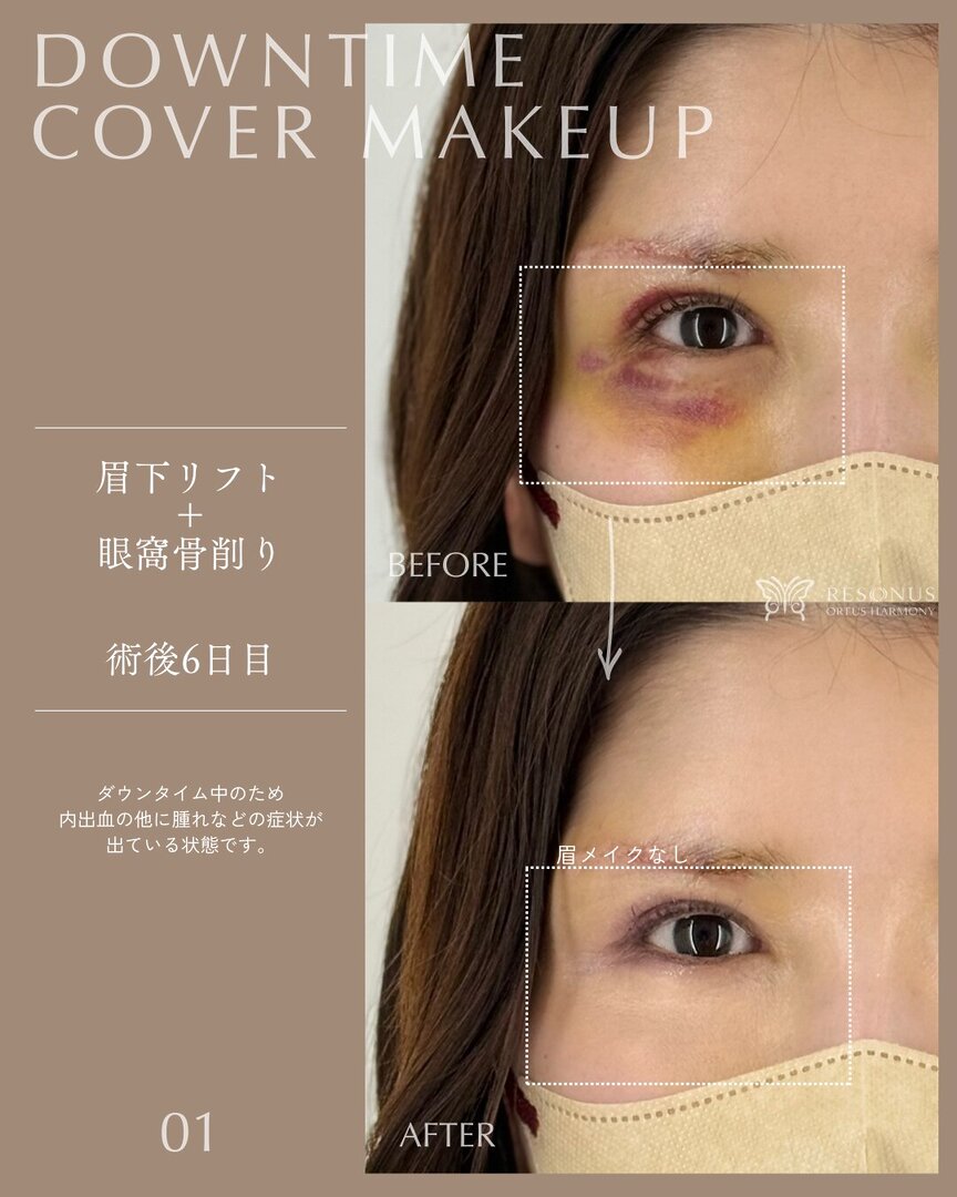 日本初!「ダウンタイムカバーメイク」という新しい選択肢 オルタス リゾナス