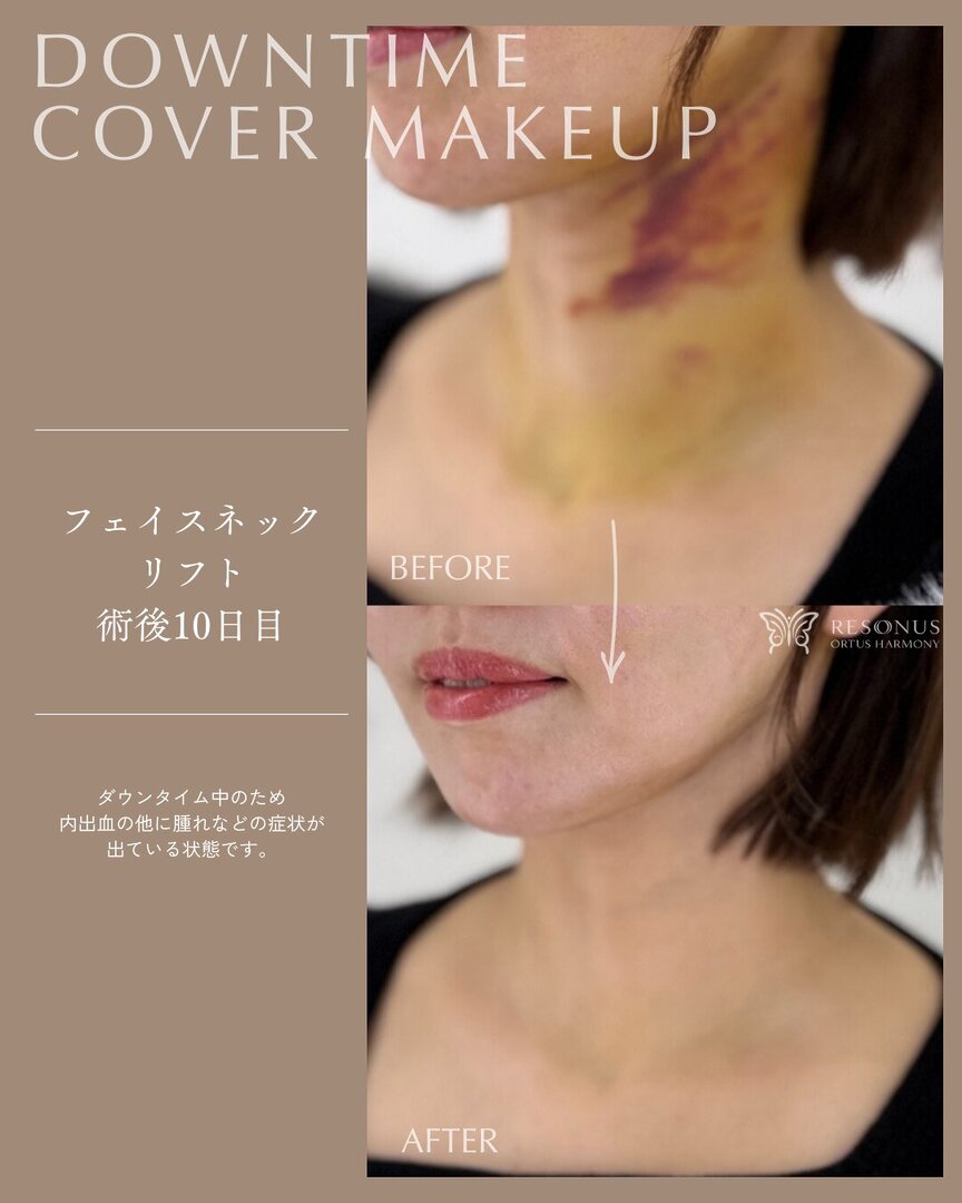 ダウンタイムカバーメイクは、内出血を科学的に打ち消す技術 オルタス リゾナス