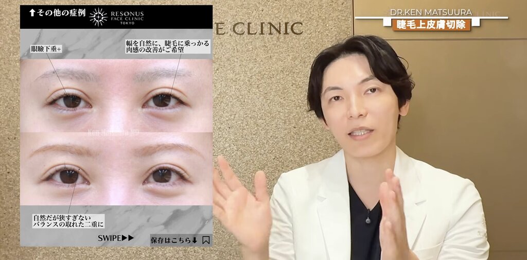 目元修正　睫毛上皮膚切除のメリット