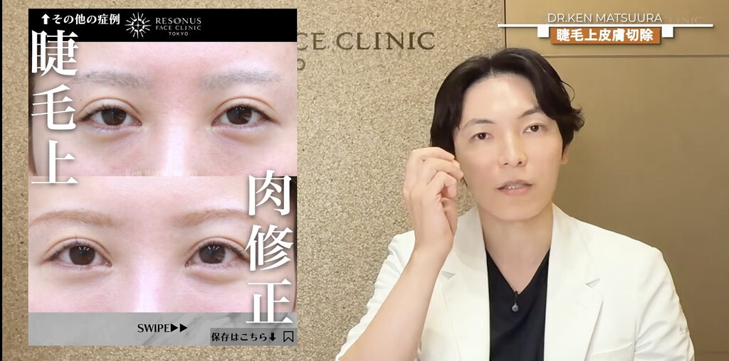 目元修正　症例1：睫毛上皮膚切除とは？ハム目状態を改善する手術