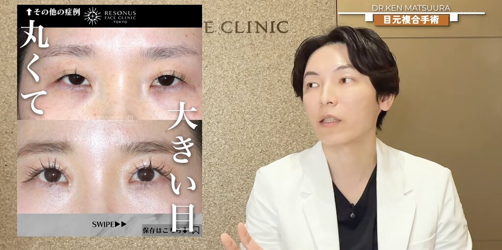 目元修正　症例2：全切開＋眼瞼下垂手術＋目頭切開の組み合わせ