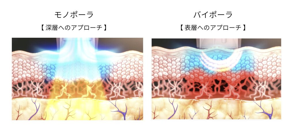 モノポーラとバイポーラを組み合わせる意味