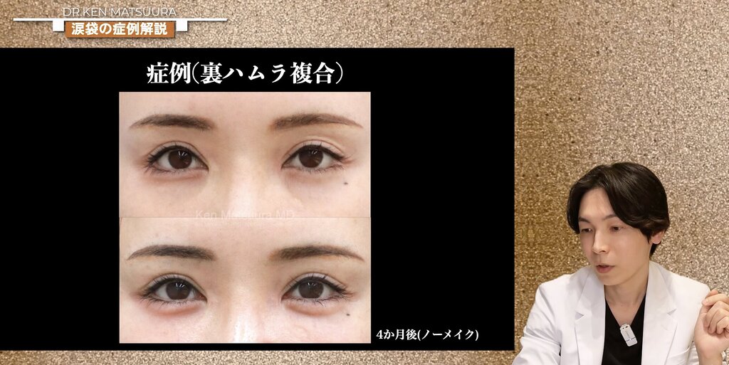 涙袋 裏ハムラと脂肪注入の組み合わせ症例
