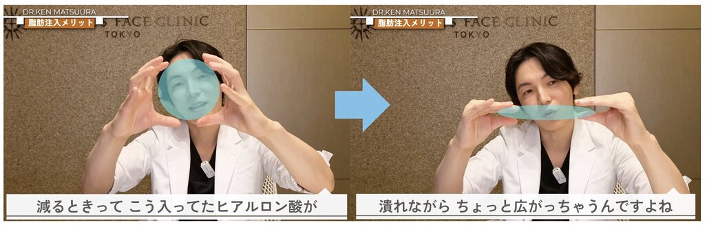 ヒアルロン酸 ボリュームが減りながらも横に広がる傾向がある