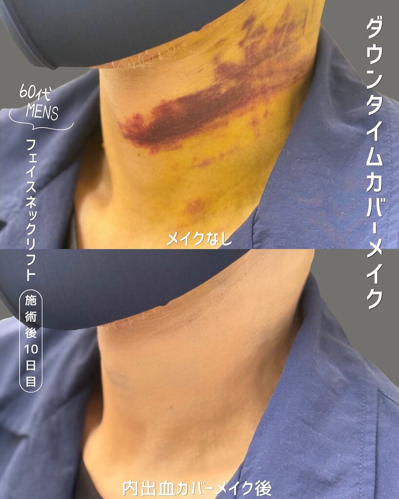 首の左半分に広がる、濃い青紫の内出血　ダウンタイムカバーメイク
