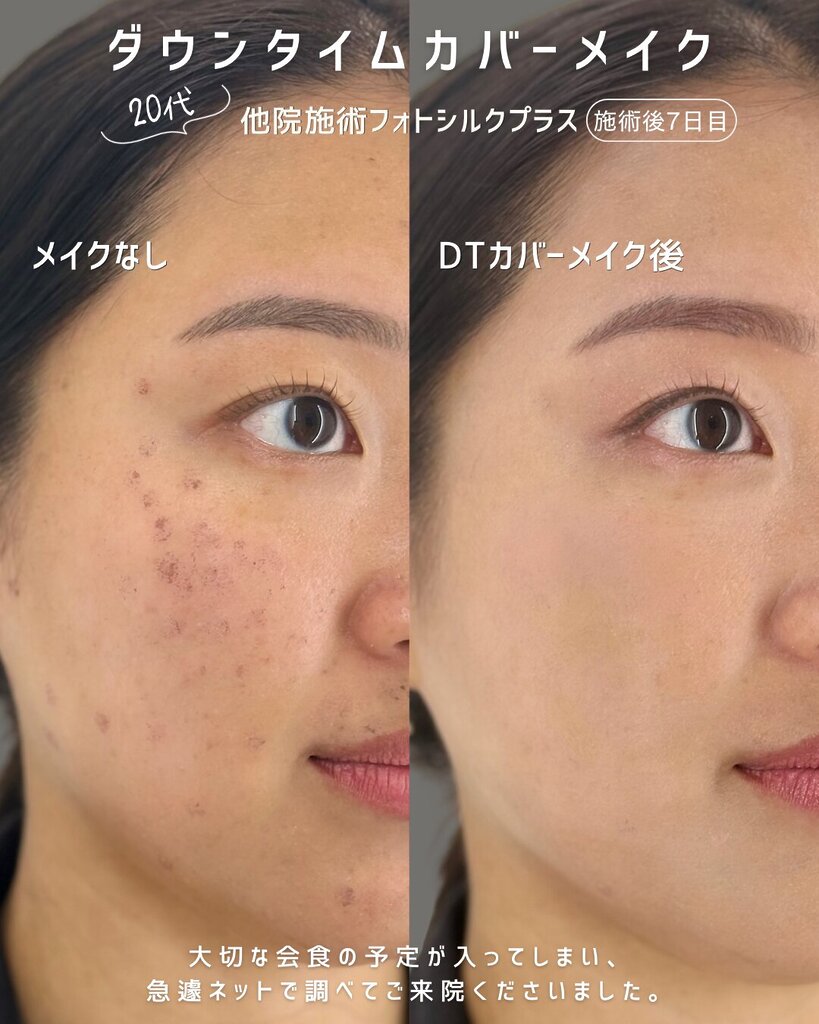 ダウンタイムカバーメイク 暑く湿気の多い季節でも崩れない「上品×キリッ」ベースメイク かさぶた