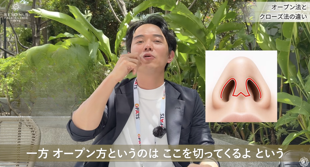 オープン法は鼻柱を切って全体を開く術式