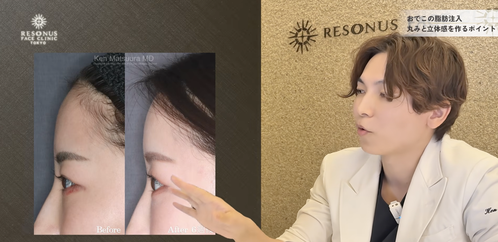 額(おでこ)への注入とピークポイントの設計