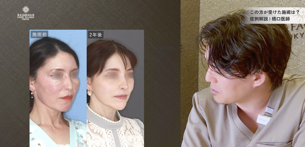 顔フル 手術前 中顔面の陥没と垂れた印象