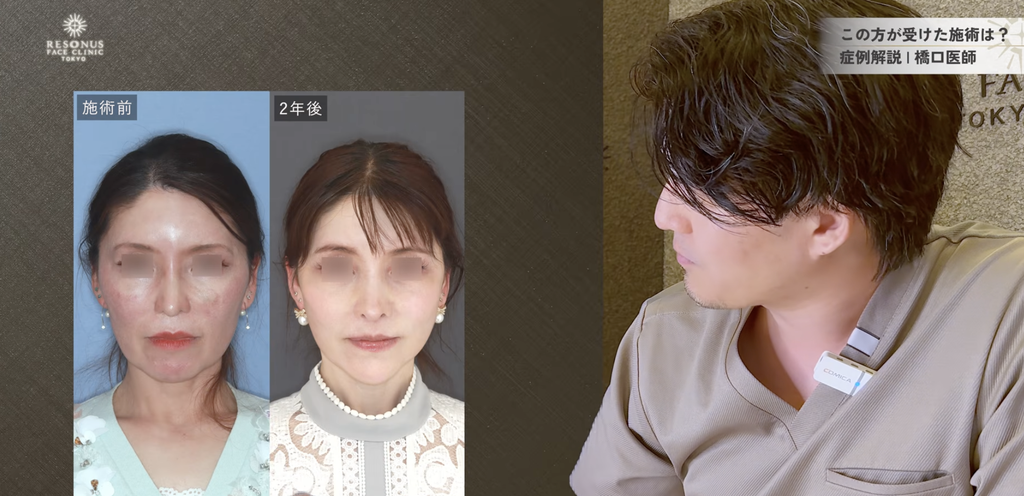 顔フル 今回の症例:術前のお顔のバランス