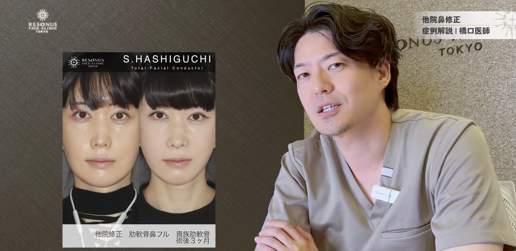 今回の症例｜軟骨が透けて四角く見えていた鼻　鼻修正　軟骨