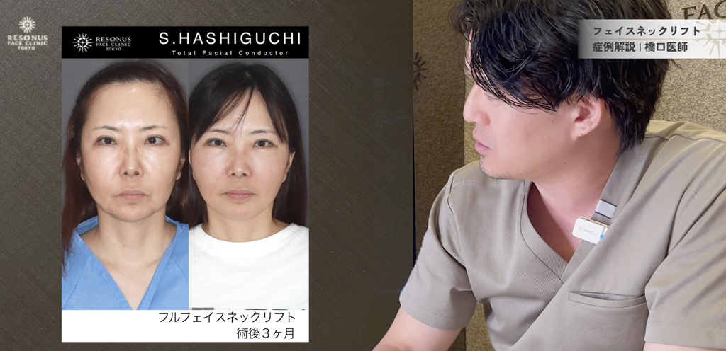 骨切り手術後にたるんだフェイスライン、フルフェイスネックリフトでどう変わった?