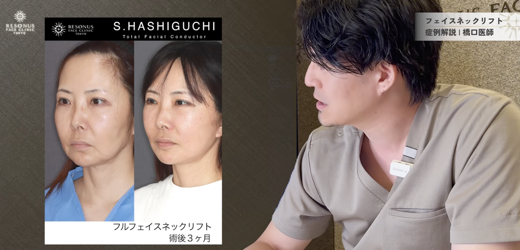 フルフェイスネックリフト 術後3ヶ月で見えた、なめらかなフェイスラインへの変化