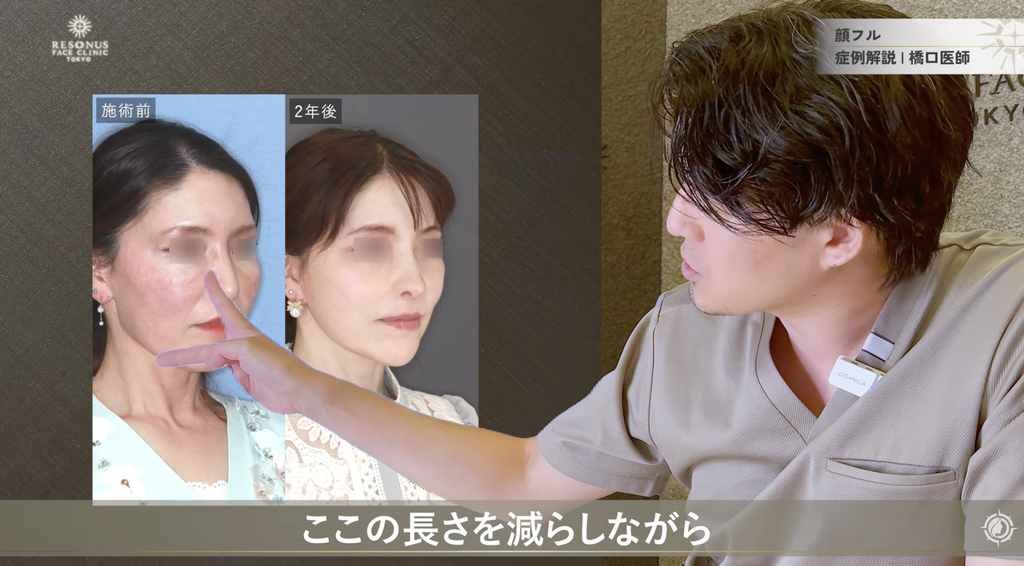 骨切りで輪郭の長さとシャープさを整える