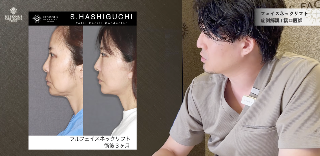 フルフェイスネックリフト術後3ヶ月 症例 リゾナス