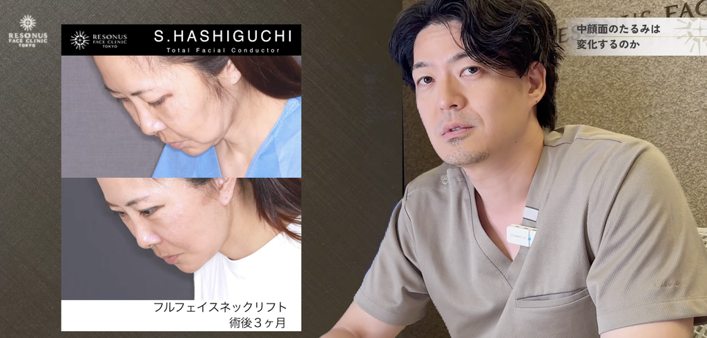 フルフェイスネックリフト 中顔面のたるみは、本当に改善しないのか