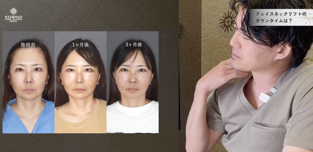 術後1ヶ月は、目元の突っ張り感が残ることも