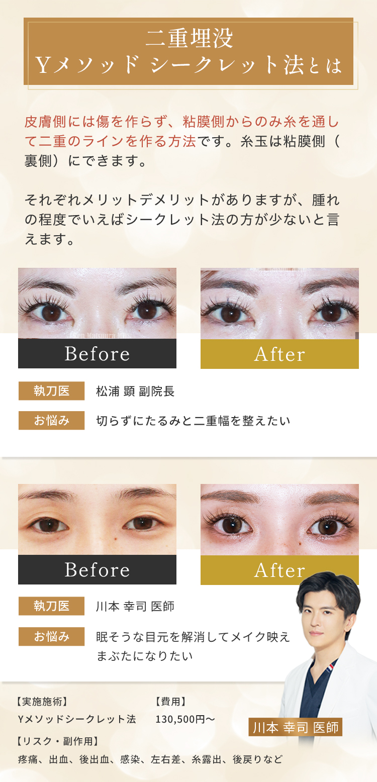 二重埋没Yメソッドシークレット法とは