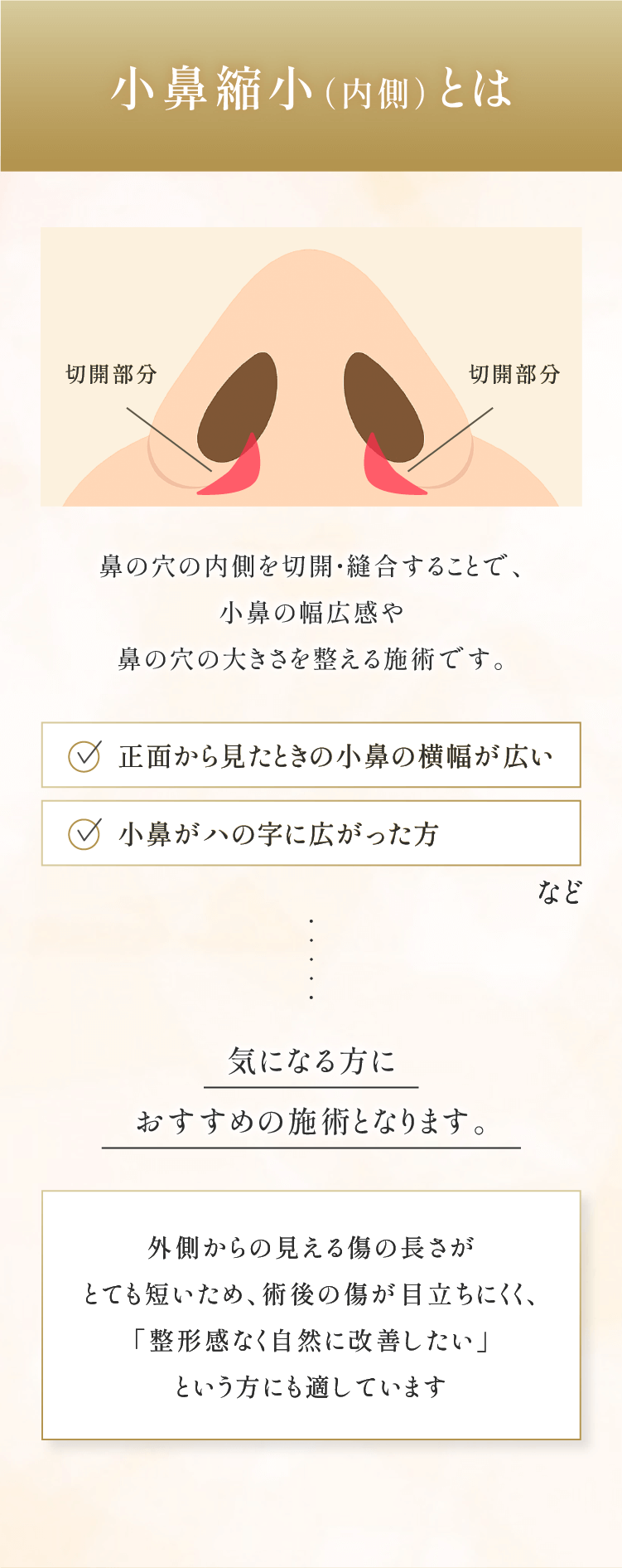 小鼻縮小（内側）とは
