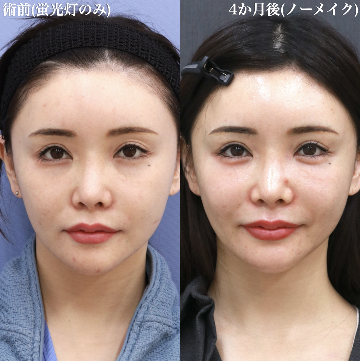 【美しい目周りを】クマ治療・ドールチーク・涙袋形成