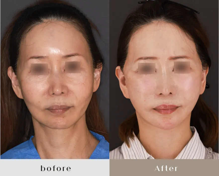 60代前半女性　正面