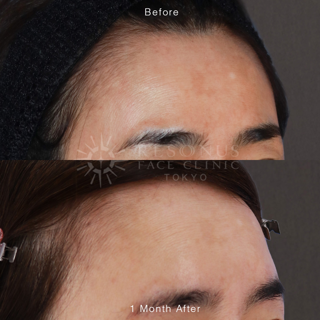 ヒアルロン酸より高コスパ？再生医療PRPF®で叶える丸く可愛いおでこ