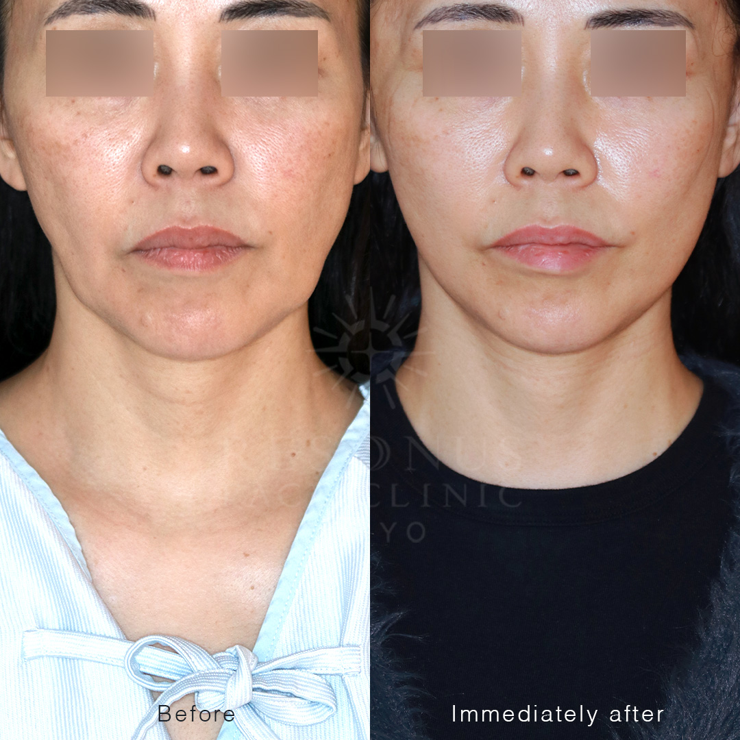 少ないお休みでも最短ダウンタイムで叶える引き締まったフェイスライン