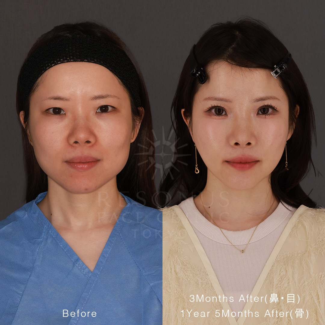 30代女性｜両顎手術をせず、輪郭3点と鼻・目元で自分らしさを残す