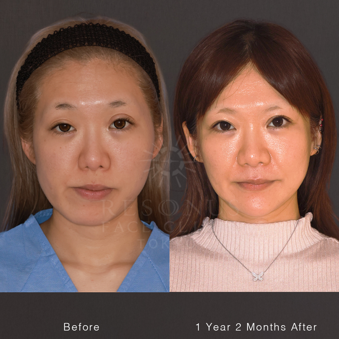 両顎手術＋輪郭３点｜交通事故で歪んだ骨も顔の長さも、どこから見ても童顔化