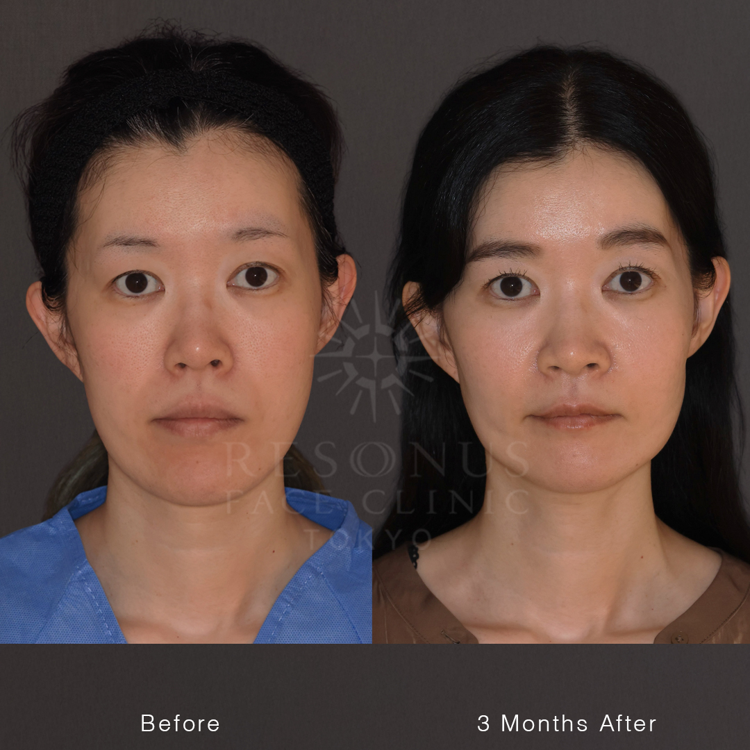 【40代】両顎手術＋Vライン｜昔から気になっていた面長。年齢とともに顔が伸びてきた