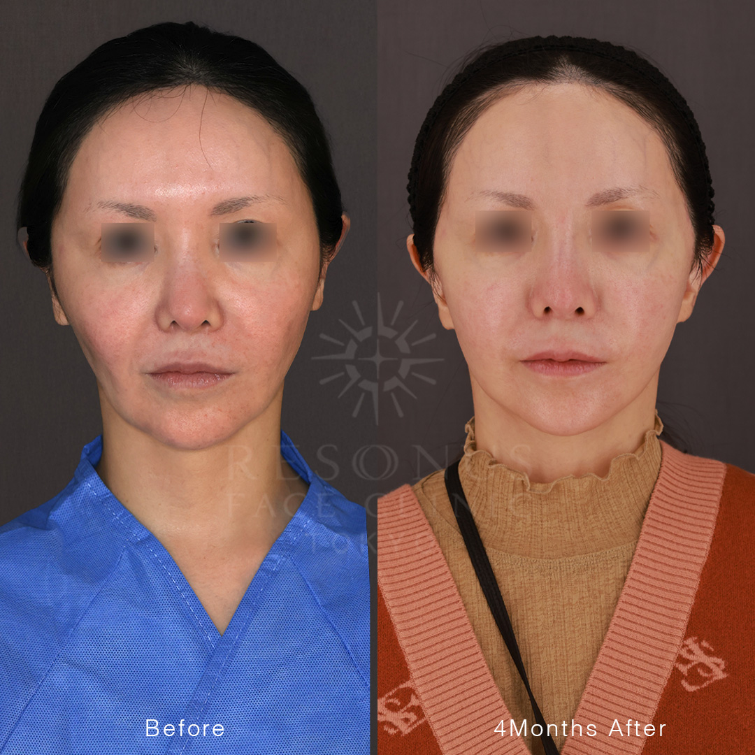 40代女性｜糸リフトや脂肪吸引で改善しなかった頬の悩みを根本から改善