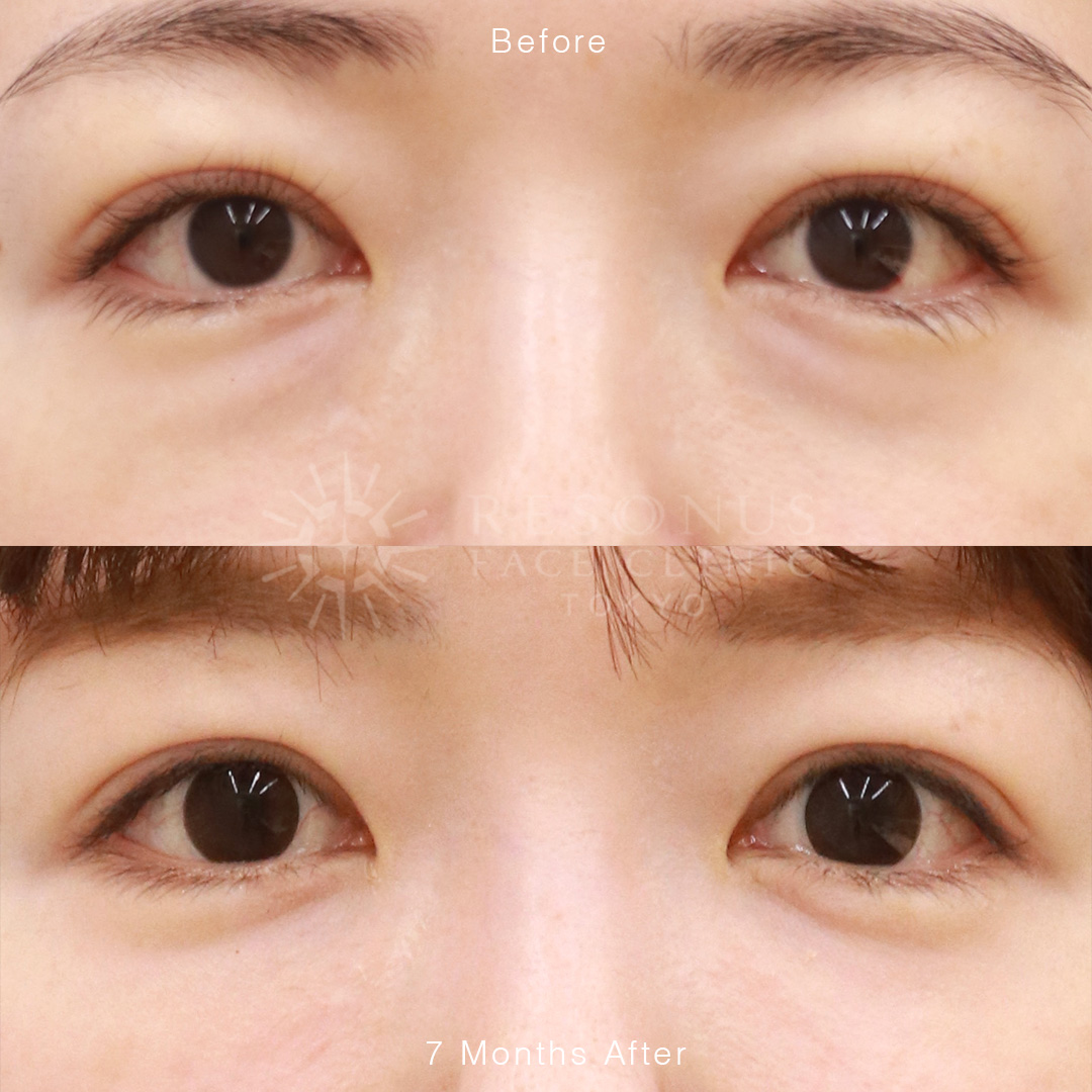 疲れ顔から【 卒業クマ治療で全体の若返り】