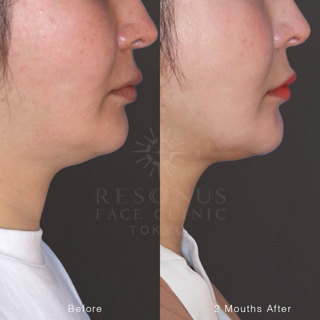 アゴ下のたるみに一撃【ドクターHIFU】シャープなフェイスライン