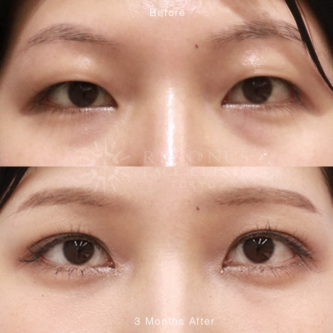 埋没二重&脱脂青グマナノファット涙袋形成【クマ治療＋α】