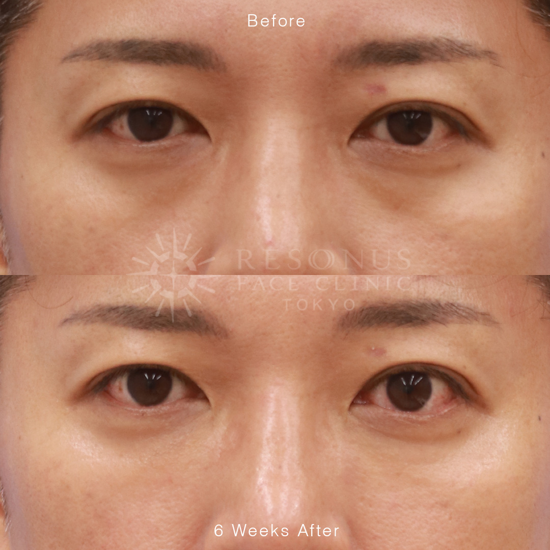 ダウンタイム少なく！切らないクマ治療【目の下ゴルゴ 再生医療PRPF®】