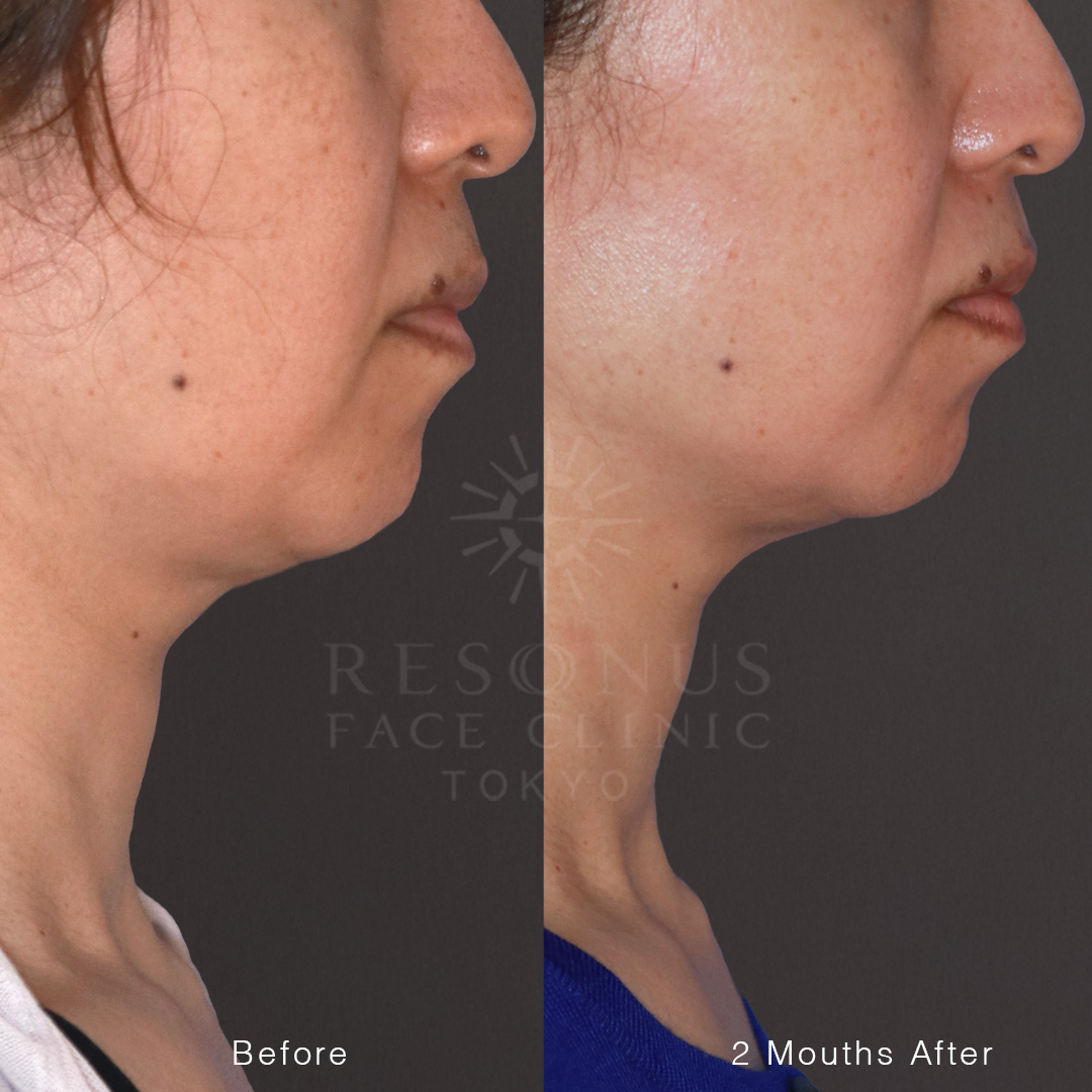 アゴ下のたるみに一撃【ドクターHIFU】切らずに輪郭すっきり引き締め